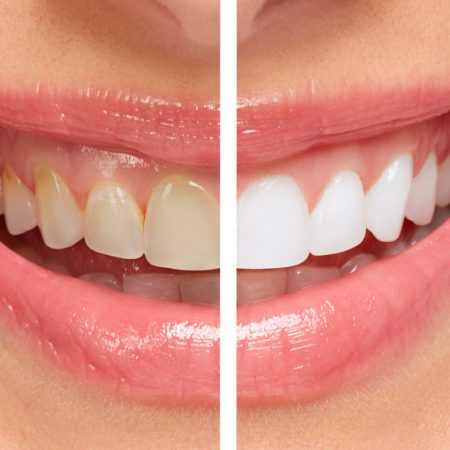Nordic SmileKit™  Whitening Kit