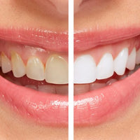 Nordic SmileKit™  Whitening Kit